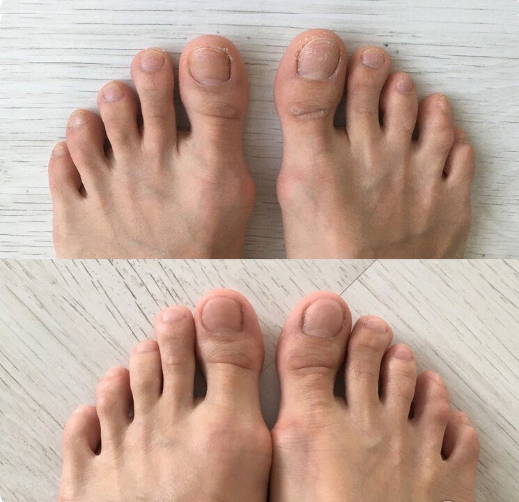 vor und nach der Anwendung von Foot Tropper Spray